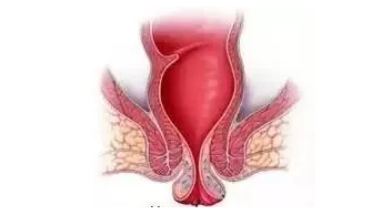 青海东大肛肠医院：肛门异物就是痔疮？