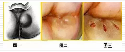青海东大肛肠医院：肛周脓肿，肛肠疾病的三大金刚之一