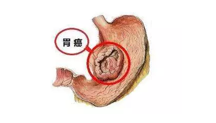 青海东大肛肠医院：别不把胃炎当回事