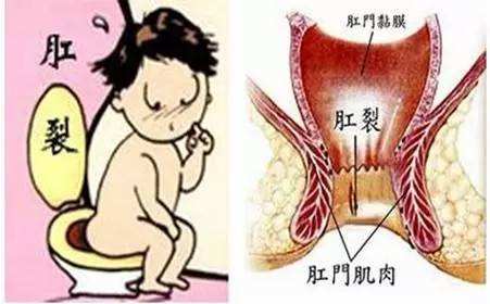 青海东大肛肠医院：肛裂能自愈么？