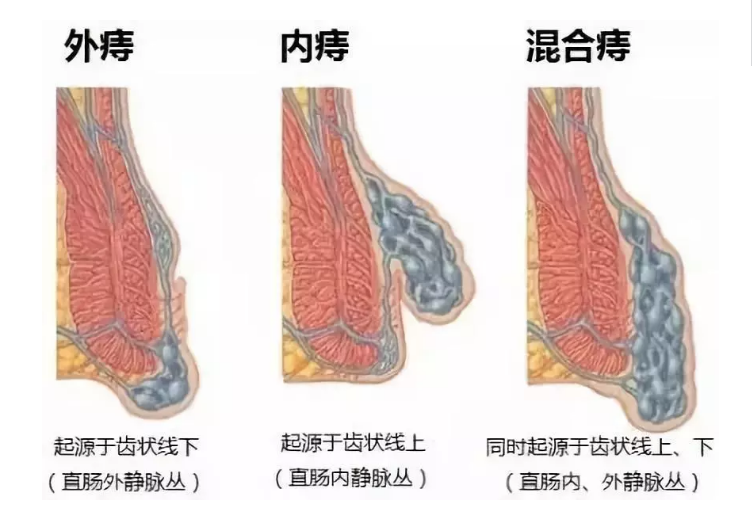 青海东大肛肠医院：脱肛是什么?你以为是痔疮吗?