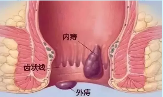 青海东大肛肠医院：如何判断自己是不是有痔疮？