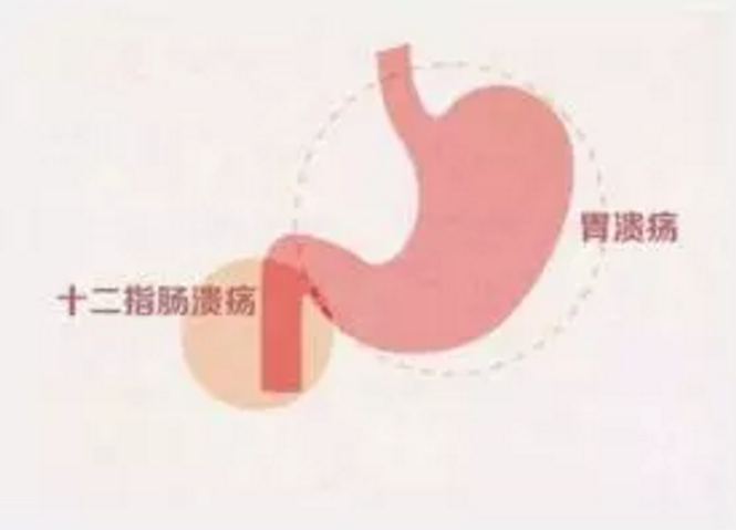 青海东大肛肠医院：胃酸可能是是胃肠道疾病？